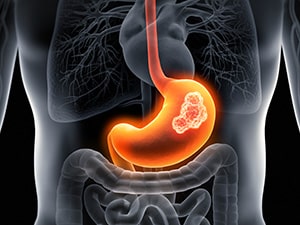 Depiction of the digestive system with a tumor in the stomach.
