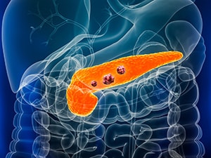 Diagram of the abdominal region with three tumors in the pancreases.