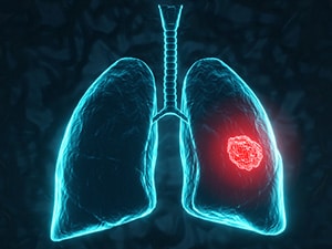Lungs with red tumor.