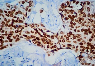 Camizestrant Granted Accelerated Approval in Combination Therapy for Certain ESR1-mutated, HR-positive Breast Cancers