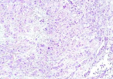 Imlunestrant Combination Approved for ESR1-Mutated Breast Cancer