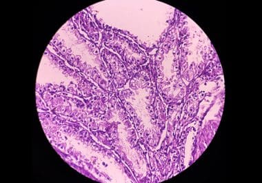 Belzutifan Plus Lenvatinib Approved for Common Kidney Cancer Type