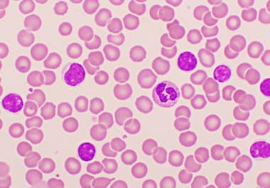 Pirtobrutinib Approved for Certain Untreated Blood Cancers