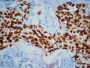 Adenocarcinoma of the breast pictured on a histopathology slide.