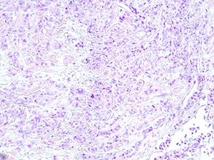 Microscopic image of breast cancer tissue.