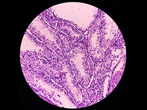 Microscope image of clear cell renal cell carcinoma.