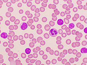 Microscope image of CLL cells